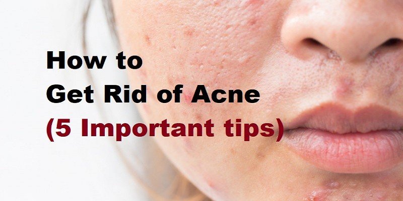How to Get Rid of Acne