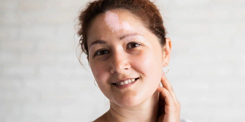 Can I Marry A Girl Whose Mother Has Vitiligo